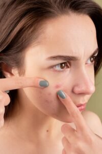 Acne and pimples