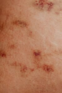 Dermatitis