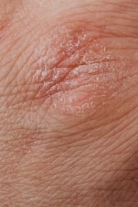 Eczema and dry skin