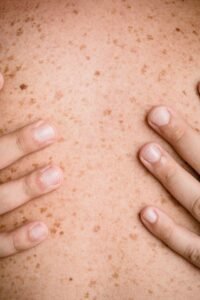 Skin rashes